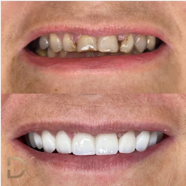 Cirkon keramicke krune pre i posle