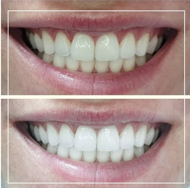 Slika pre i posle izebljivanja zuba u ordinaciji