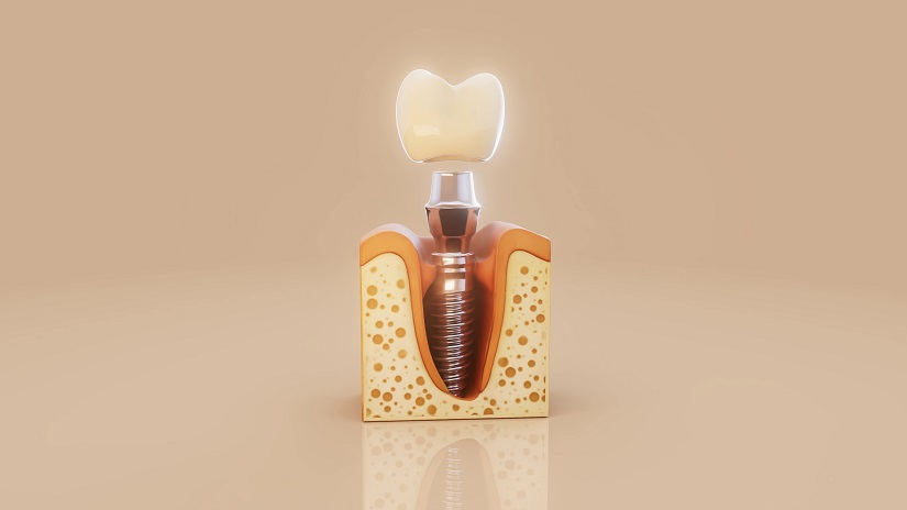 3D prikaz zubnog implanta