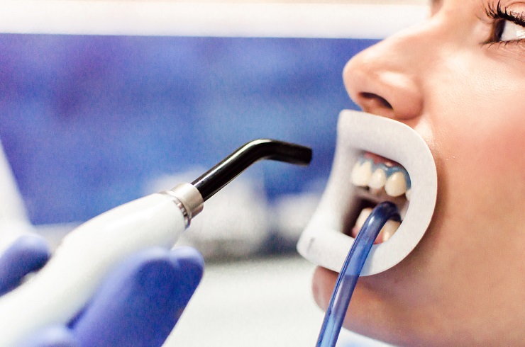 Devojka na zubarskoj stolici gde se vide tacno zubi sa gelom za izbeljivanje i lampom koja prilazi ustima