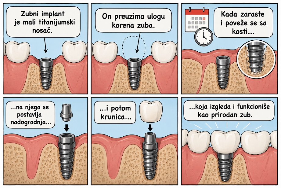 Sematiski prikaz implanta, abatmenta i zubne krune