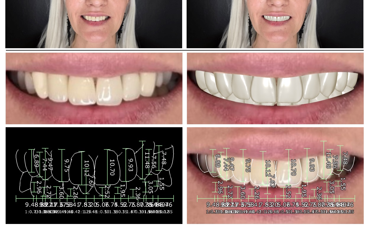 Slika digital smile designa Dentalia 1