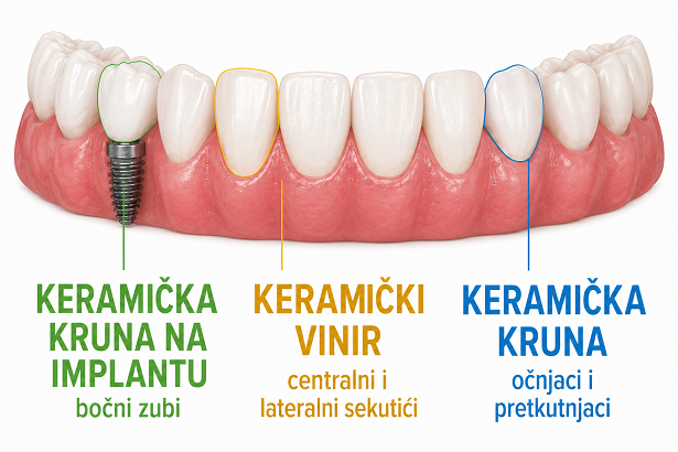 U jednom osmehu keramicka, kruna, vinir i kruna na implantu